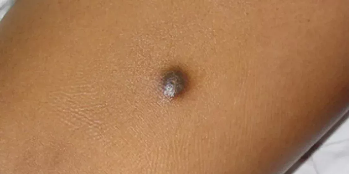 dermatosis dermatosis