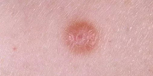 dermatosis2 dermatosis2
